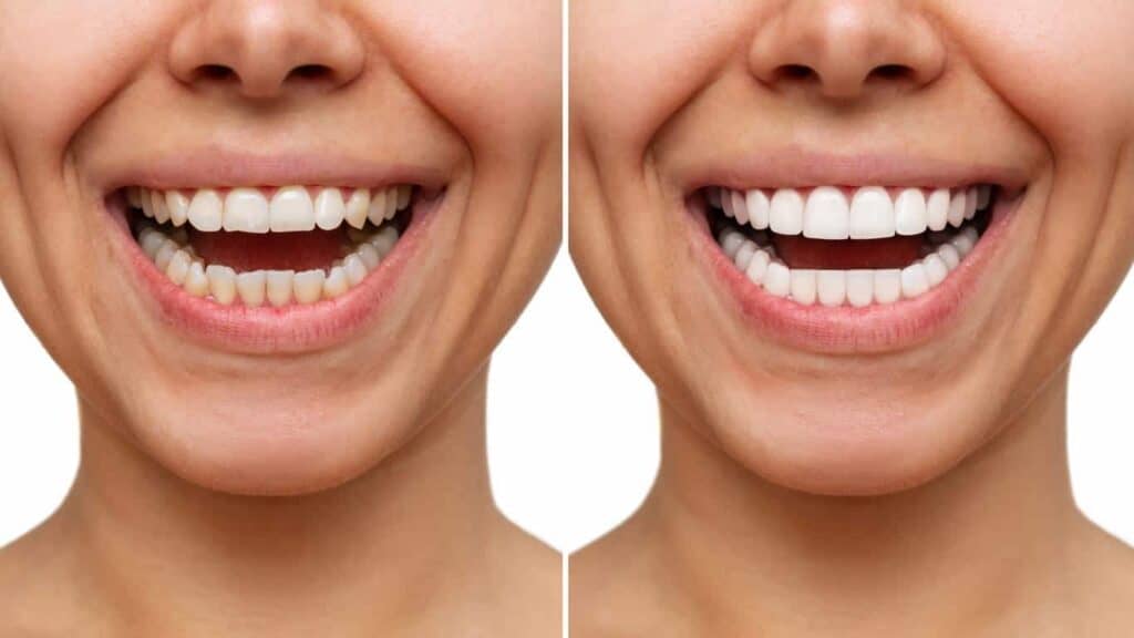 Before and after teeth whitening results. Bournemouth