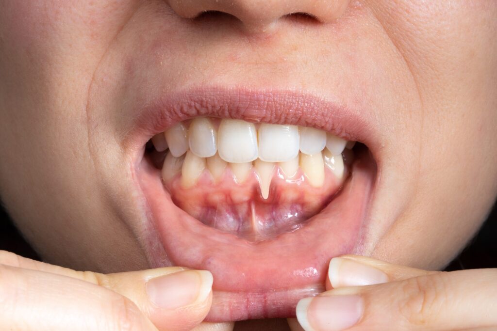 Preparing for teeth whitening with receding gums Bournemouth