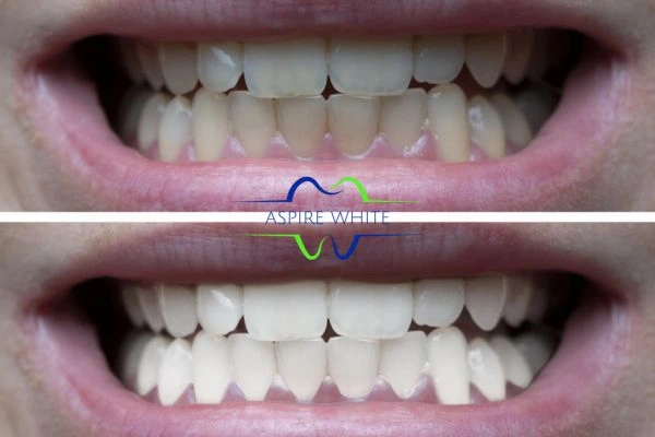 1 hour laser teeth whitening before and after results Bournemouth
