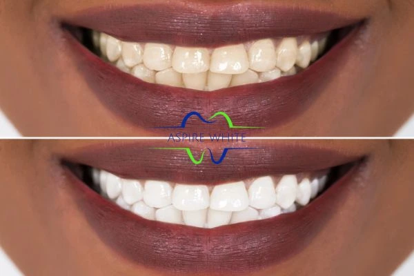 before After results 6 1